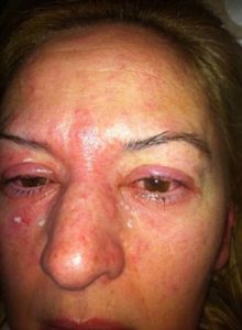 Eyelash Extension Risks